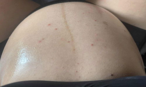 ตั้งครรภ์ไตรมาส3แล้วอยู่ๆมีตุ่มแบบนี้ขึ้นตามกลัวเป็นอะไรไหมคะ