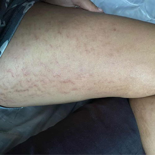 คันมากเลยค่ะ