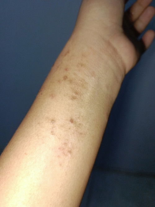 Gatal pada ibu hamil