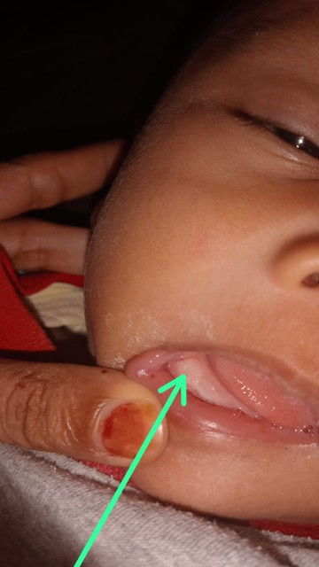 Bun itu gigi yha kok gusi eh aboh yha Bun kasih obat apa yha Bun apa benar itu gigi atau sariawan bu