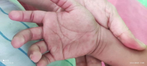 Mie alm nyu poba kng ano tuh red spot sa kamay ng ank ko sa paa kc nya mron daw tas makatikamot