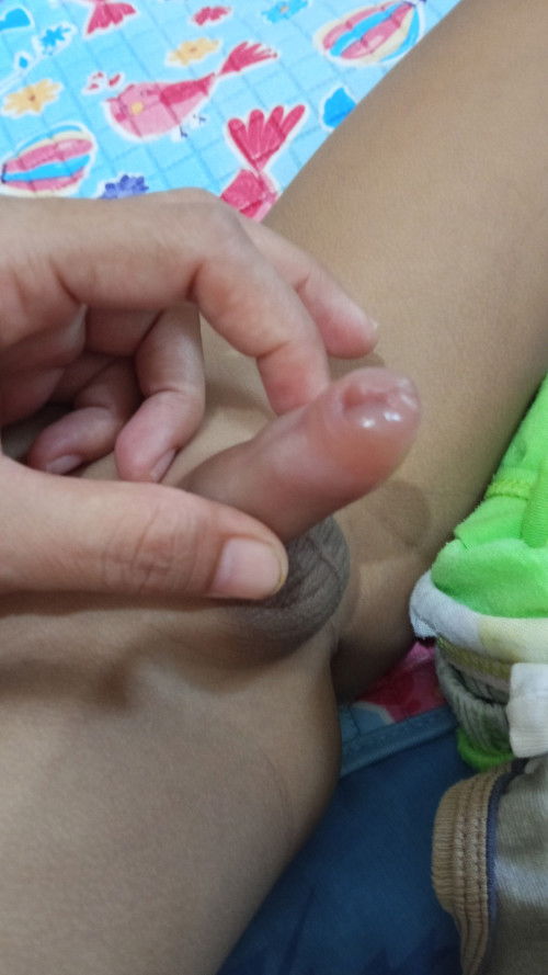 Penis anak 3th bengkak
