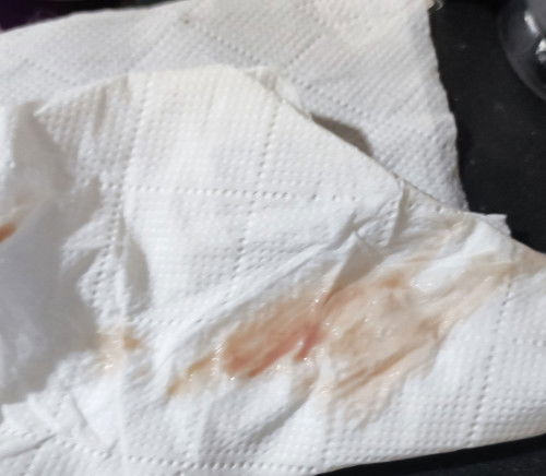 ตกขาวอันตรายกว่าที่คิด