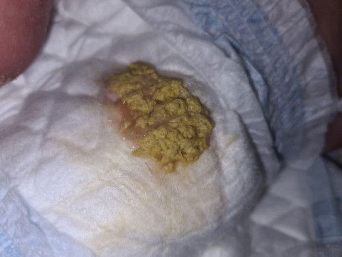 normal ba ang poop  ni baby?