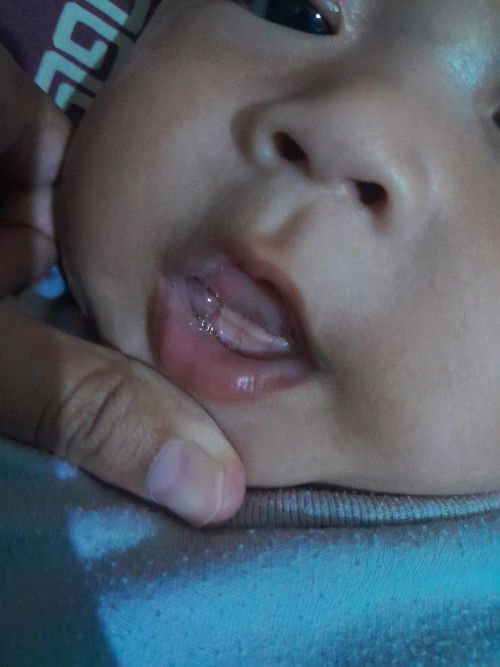 Gusi bayi bengkak