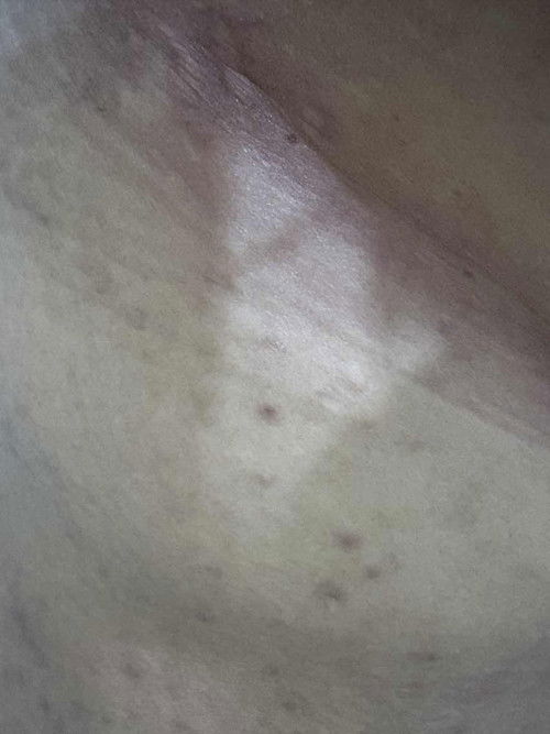 Gatal2 seluruh badan