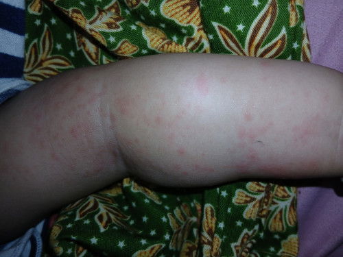 Alergi atau Ruam (karena cuaca disini panas)