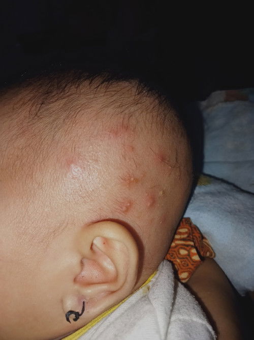 Kepala bayi beruntusan