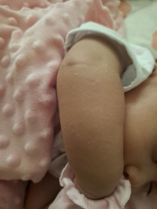 ผื่นขึ้นเเขนขา