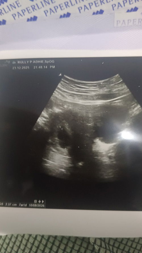 Diagnosa dokter hamil BO beda 2 minggu