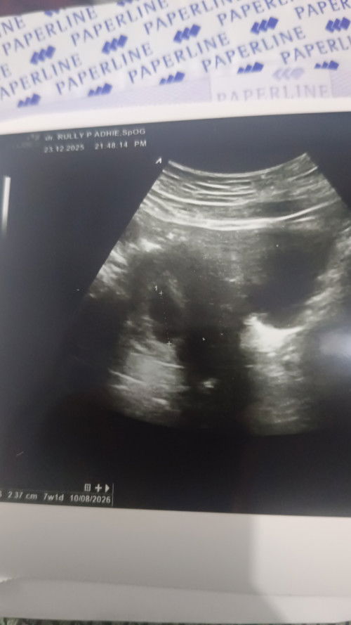 Diagnosa dokter hamil BO beda 2 minggu