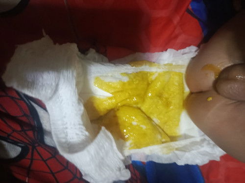 POOP NI BABY

Normal lng Po ba to? Higit 3x na Po Sya nag poop Ng Gnyan Ngayong Araw 4 Bwan Si baby