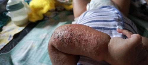 Luka pada bayi