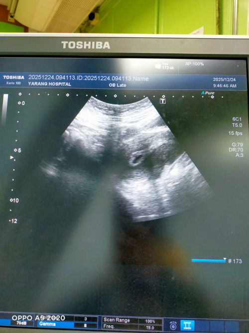 ภาวะแท้ง.ท้องลม