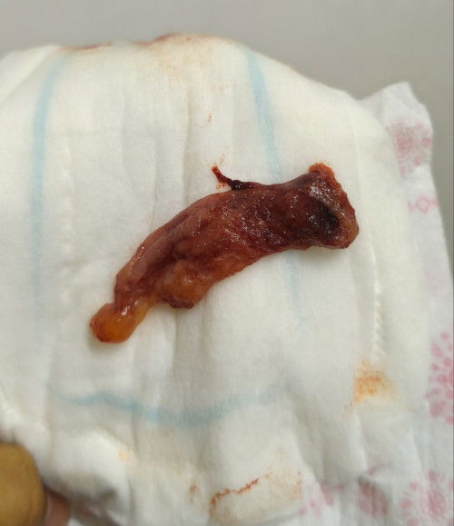 Bleeding dan keluar ketulan