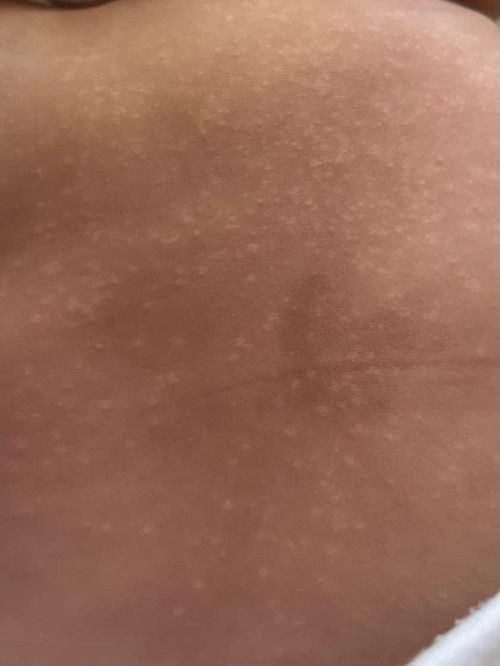 ผื่นแบบนี้แพ้อะไรคะ