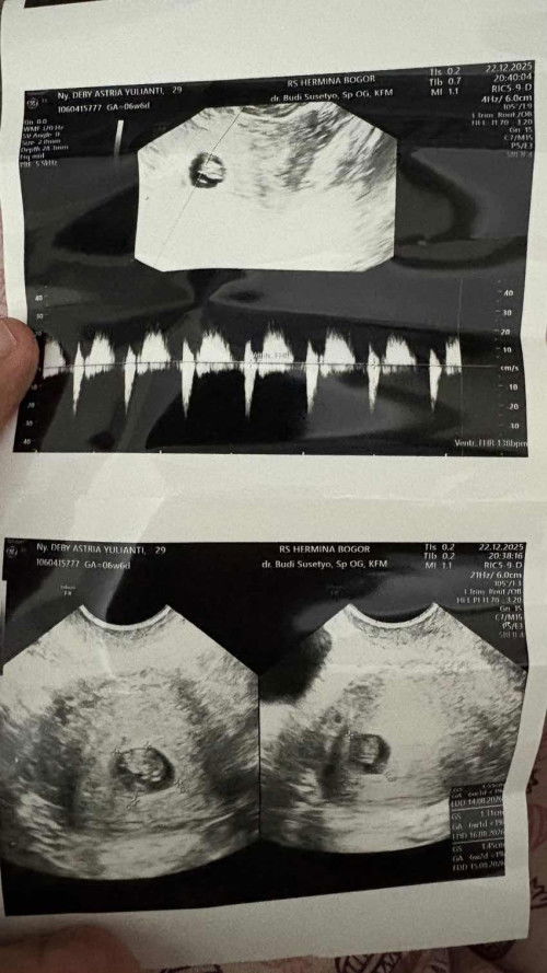 Hamil 9 Week dan pernah 3x keguguran