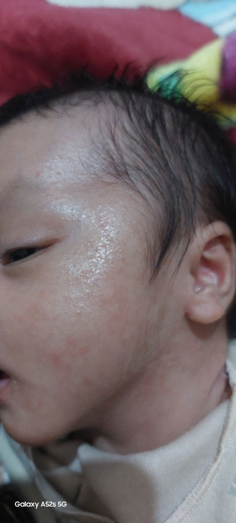 Bintik pd wajah bayi