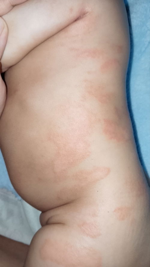 ลูกบ้านไหนเคยเป็นผื่นแบบนี้บ้างคะ?