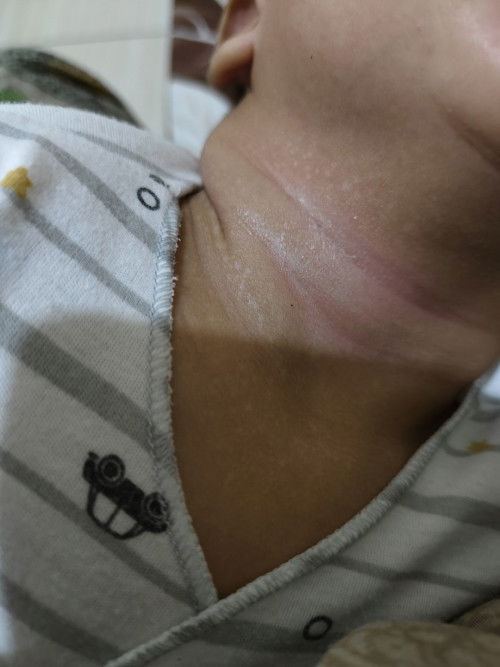 Bercak putih di leher