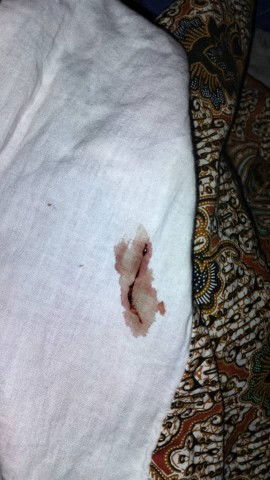 DEMAM Trimester ke 3