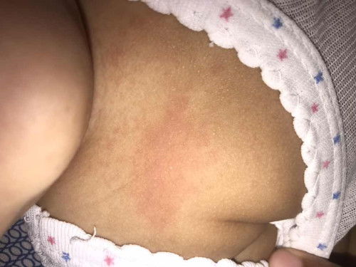 Ruam pada tubuh bayi