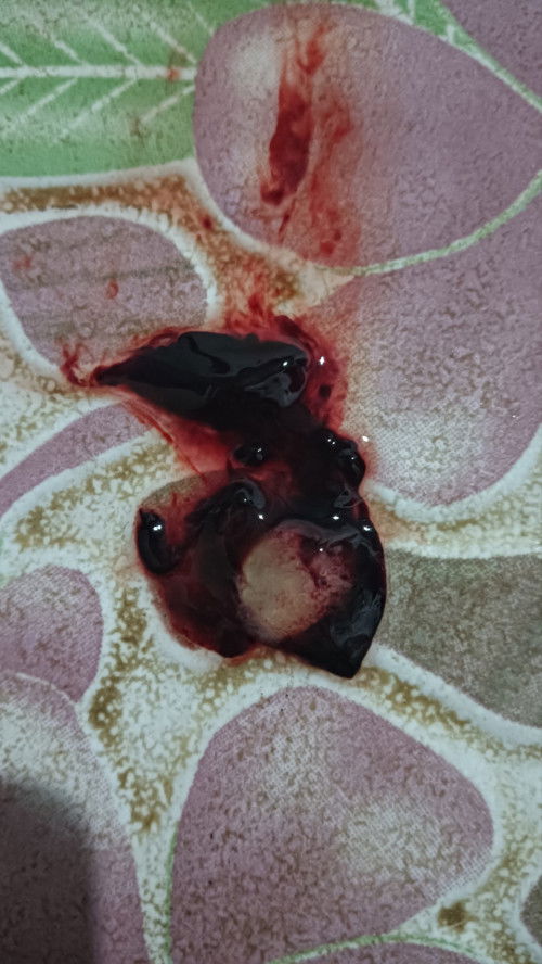 สภาวะแท้งคุกคาม