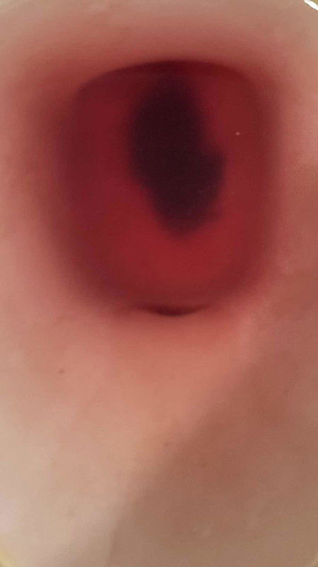 เลือดออกตอนตั้งครรภ์