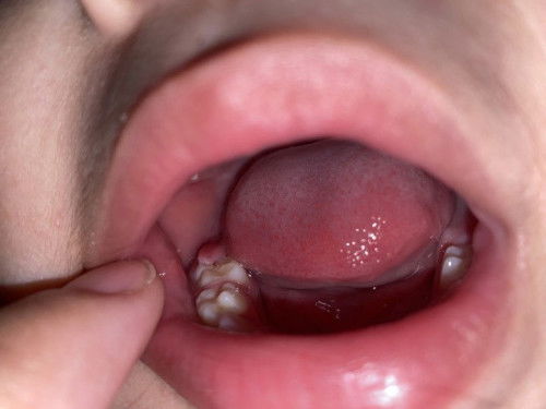 Ano po kaya tong nasa gums ng anak ko parang laman siya and normal lang po ba to?