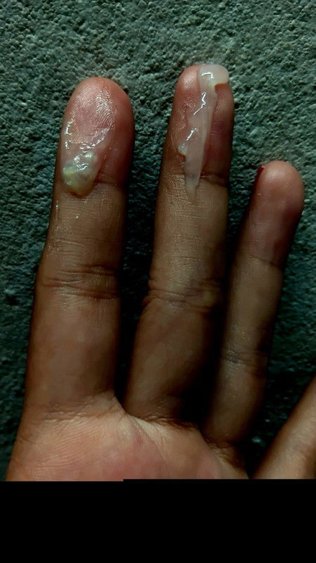 ท้อง32สัปดาห์1วัน เป็นมูกเลือดหรือตกขาวค่ะดูให้หน่อย สีเหลืองใสข้นเหมือนเหนียว