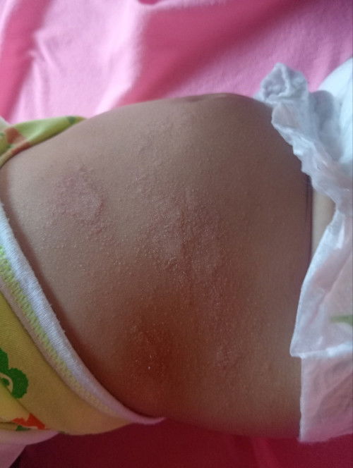 ผื่นบนตัวน้อง