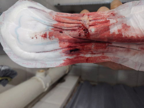 Ni dikira keguguran ke? Sakit sperti contraction berpanjangan