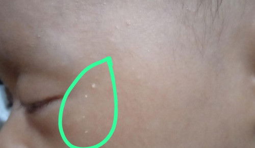 bintik di muka bayi