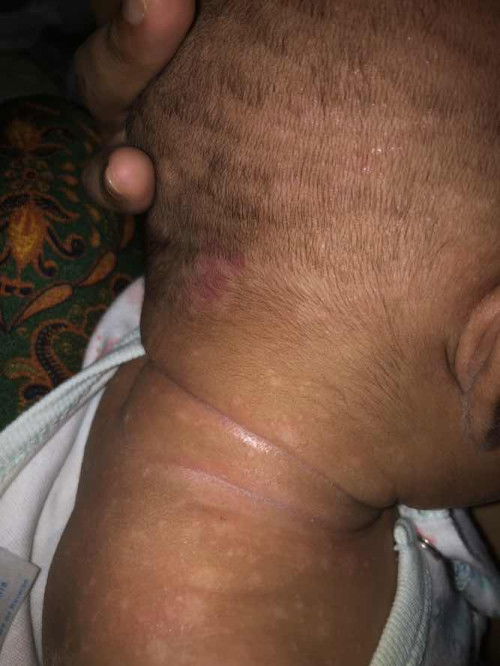 Ada yang tau tak ni kenapa? Anak sy ni naik banyak jgk kat bhg leher nak sampai ke kepala 🥲