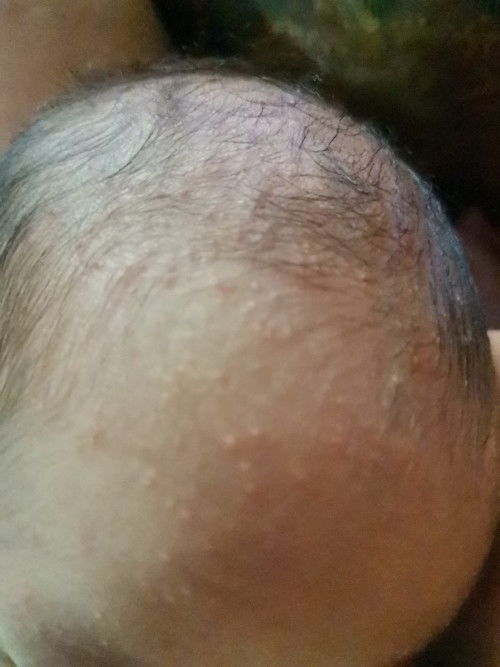 Mga mii ano po ito? tyaka normal ba ito na my ganyan sa newborn ? salamat sa makakasagot.