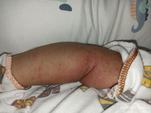 Ruam merah newborn