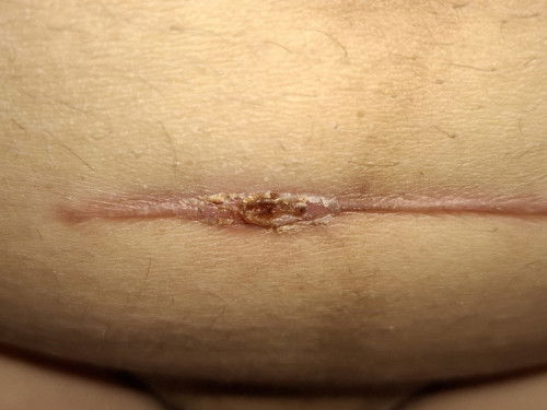 คลอดธรรมชาติ+ทำหมัน