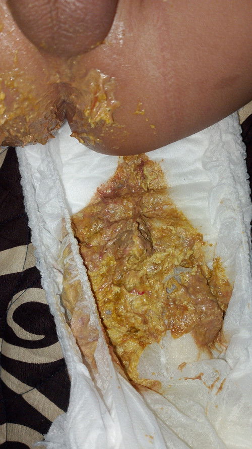 Pup bayi campur darah