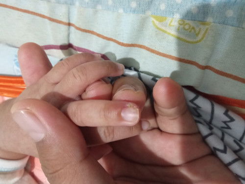Nanah di kuku bayi umur 1 bulan