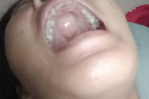 Ketika hamil ada benjolan di langit²