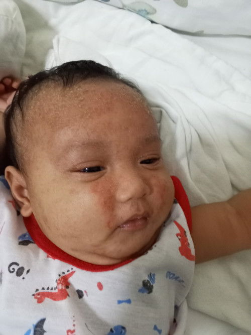 Cradle cap and rashes 2 months and 13 days old baby boy. Cetaphil soap. Using cicastela now. Same.
