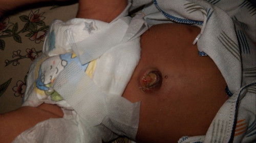 Pusar bayi keluar cairan kuning dan berbau nanah