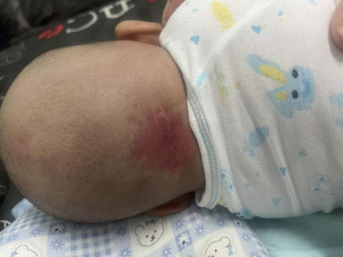 รอยแดงบนหนังศีรษะ