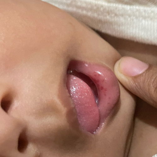 Merah merah dalam bibir bayi