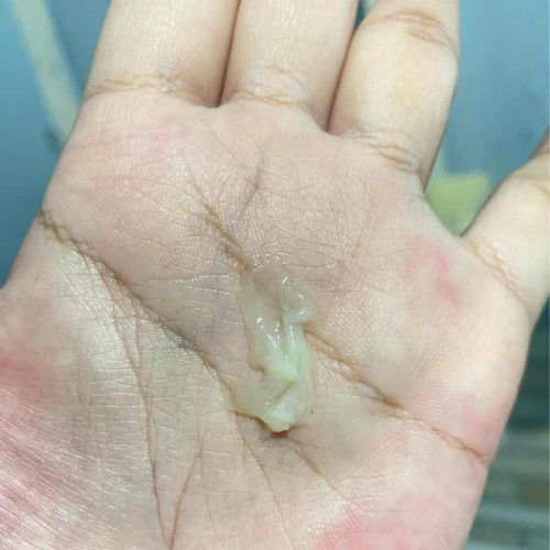 อันนี่มูกใสหรือตกขาวคะ 33+5 อันตรายมั้ยคะ