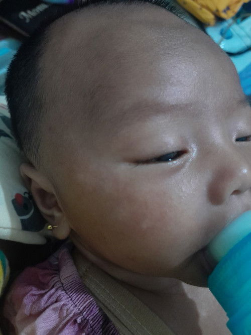 Bercak bercak putih di muka bayi