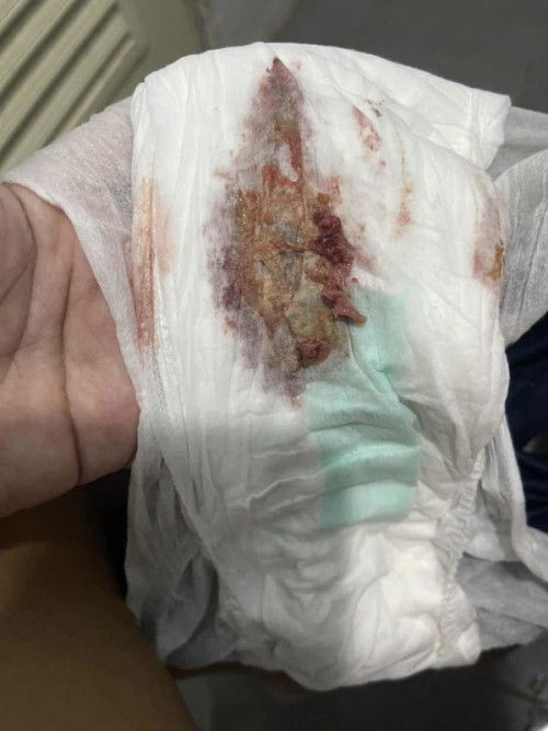 หลังคลอด1เดือน3วัน อยู่ๆมีก้อนแบบนี้ออกมา ผิดปกติมั้ยค่ะ