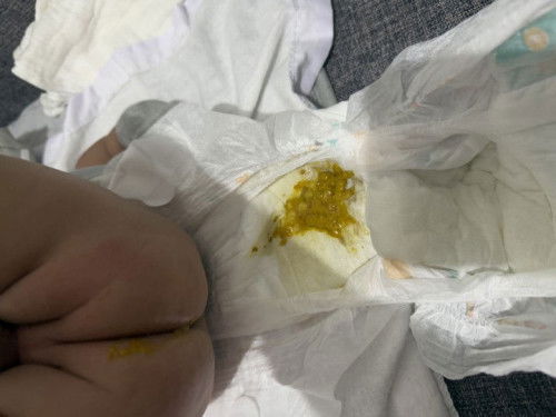 Mga mommies ask ko lng ganito kasi poops ni l.o and pang 5 na to today