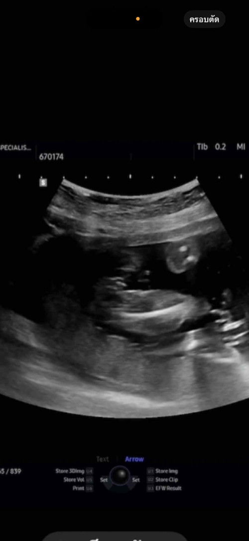 ตั้งครรภ์ ถามเพศลูก