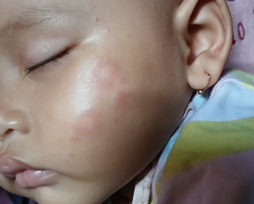 Merah merah pada kulit bayi